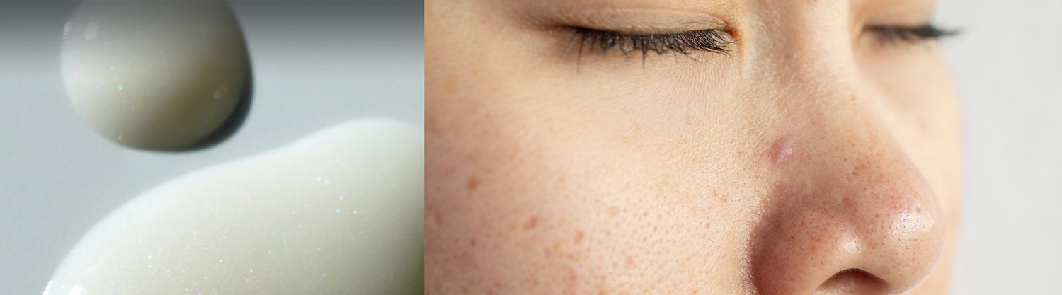 split image of lotion drops and a persons face with some acne marks