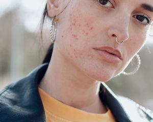 how to reduce acne redness