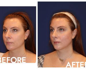 Emface treatment botox alternative before and after photo