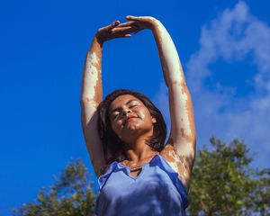 Woman with vitiligo standing in the sun