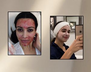 Microneedling with PRP Vampire Facial