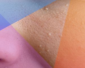 what are fordyce spots?