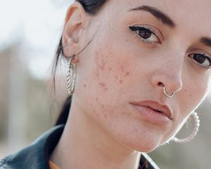 Woman with acne and redness