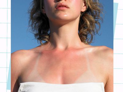 essential oils for sunburn