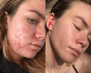 woman's spironolactone before and after photo